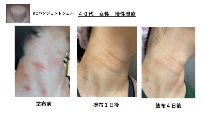 円形脱毛症　病院